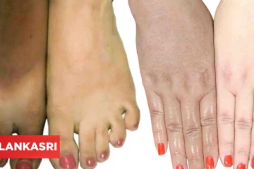 உங்க கருப்பான கைகளையும் கால்களையும் வெள்ளையாக மாற்ற வேண்டுமா? இதை செய்தாலே போதும்...!