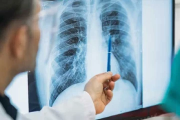 වසරකට ක්ෂය රෝගීන් 8,500–9,500ක් වැඩිම බස්නාහිර පළාතේ