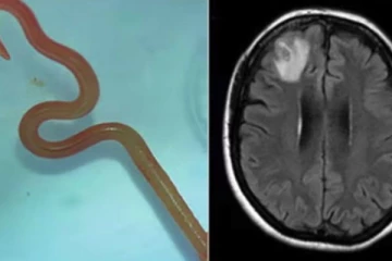 உலகில் முதன் முதலில் பெண் ஒருவரின் மூளையில் இருந்து உயிருள்ள புழு கண்டுபிடிப்பு