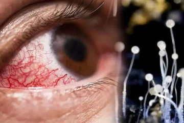 கோவையில் 6 பேருக்கு கரும்பூஞ்சை உறுதி! கலெக்டர் நாகராஜன் தகவல்