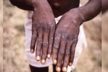 භයානක තත්වයක් එම්පොක්ස් බිය ලෝකය පුරා පතුරවමින්.. රෝගීන් පාකිස්තානයෙන්ත් වාර්තාවෙයි..