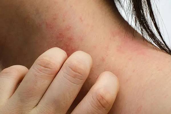 Red Spots on Skin: சருமத்தில் தோன்றும் சிவப்பு புள்ளிகள் ஆபத்தானதா? மருத்துவ விளக்கம் | Whats The Reson Behaind Red Spots On Skin