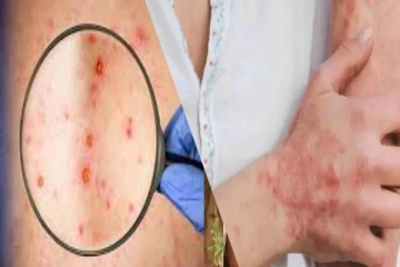 குரங்கு அம்மை நோய் பாதிப்பை முதன் முறையாக உறுதி செய்தது கனடா