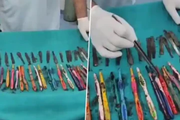 வாலிபர் வயிற்றில் 29 கரண்டிகள், 19 பிரஷ்கள்: அதிர்ச்சியில் மருத்துவர்கள்!