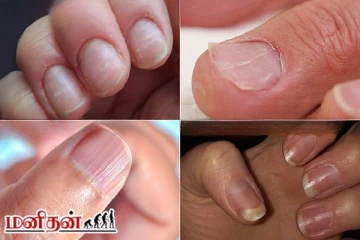 நகங்களின் வடிவத்தை வைத்தே உங்கள் நோயை கணிக்கலாம்...உங்கள் நகம் எப்படி?