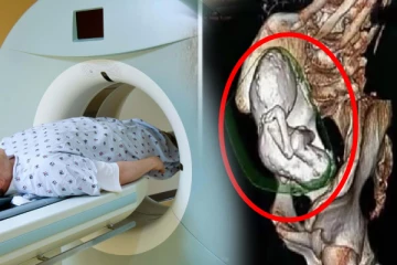 கால்சிய கல்லாக மாறிய சிசு; 75 வயது பெண்ணின் CT SCAN ஆல் மருத்துவர்கள் அதிர்ச்சி