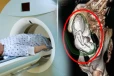 கால்சிய கல்லாக மாறிய சிசு; 75 வயது பெண்ணின் CT SCAN ஆல் மருத்துவர்கள் அதிர்ச்சி