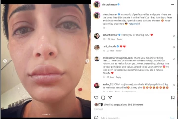 முகம், கண் வீங்கிய நிலையில்.. ஸ்ருதிஹாசனுக்கு வந்த நோய்! புகைப்படத்தால் அதிர்ச்சியில் ரசிகர்கள்