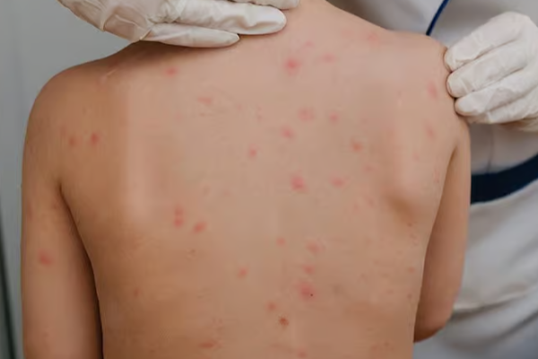 தட்டம்மை குறித்து கனடாவிற்கு விடுக்கப்பட்டுள்ள எச்சரிக்கை | Measles Alert Urges Countries Including Canada