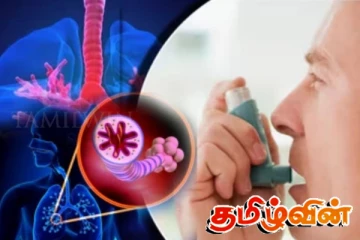 உலகளவில் 100000 பேரில் 3340 பேருக்கு ஆஸ்துமா இருப்பதாக தகவல்