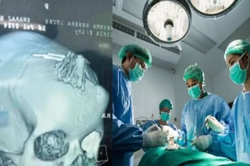 தலையில் 77 ஊசிகளுடன் இருந்த பெண்..மிரண்டுபோன மருத்துவர்கள் - வெளியான பகீர் தகவல்!