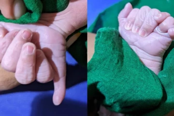 25 விரல்களுடன் பிறந்த அதிசய குழந்தை; ஆச்சர்யத்தை ஏற்படுத்திய சம்பவம்