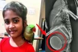 கிளியின் உடலில் சிக்கிய முட்டை... உயிரை காப்பாற்ற போராடும் சிறுமி!