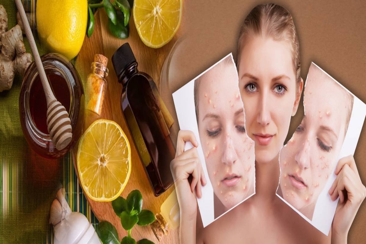 செலவே இல்லாம முகப்பருவுக்கு முடிவு கட்டணுமா? இந்த வீட்டு வைத்தியம் போதும்! | Best Home Remedies To Remove Acne Naturally