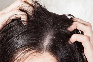 பொடுகை அடியோடு நீக்க வேண்டுமா? அப்போ இந்த ஆயுர்வேத எண்ணெயை தினமும் பயன்படுத்துங்க போதும்