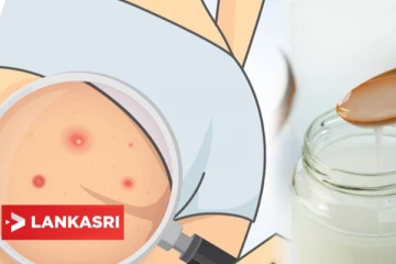 பிட்டத்தில் பருக்கள் எளிய முறையில் போக்கனுமா? இதோ சூப்பரான டிப்ஸ்