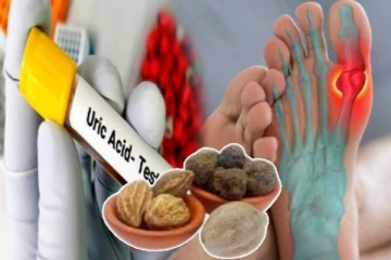 யூரிக் அமில பிரச்சினைக்கு என்ன காரணம்? ஆயுள் வேத சிகிச்சையில் தீர்வு