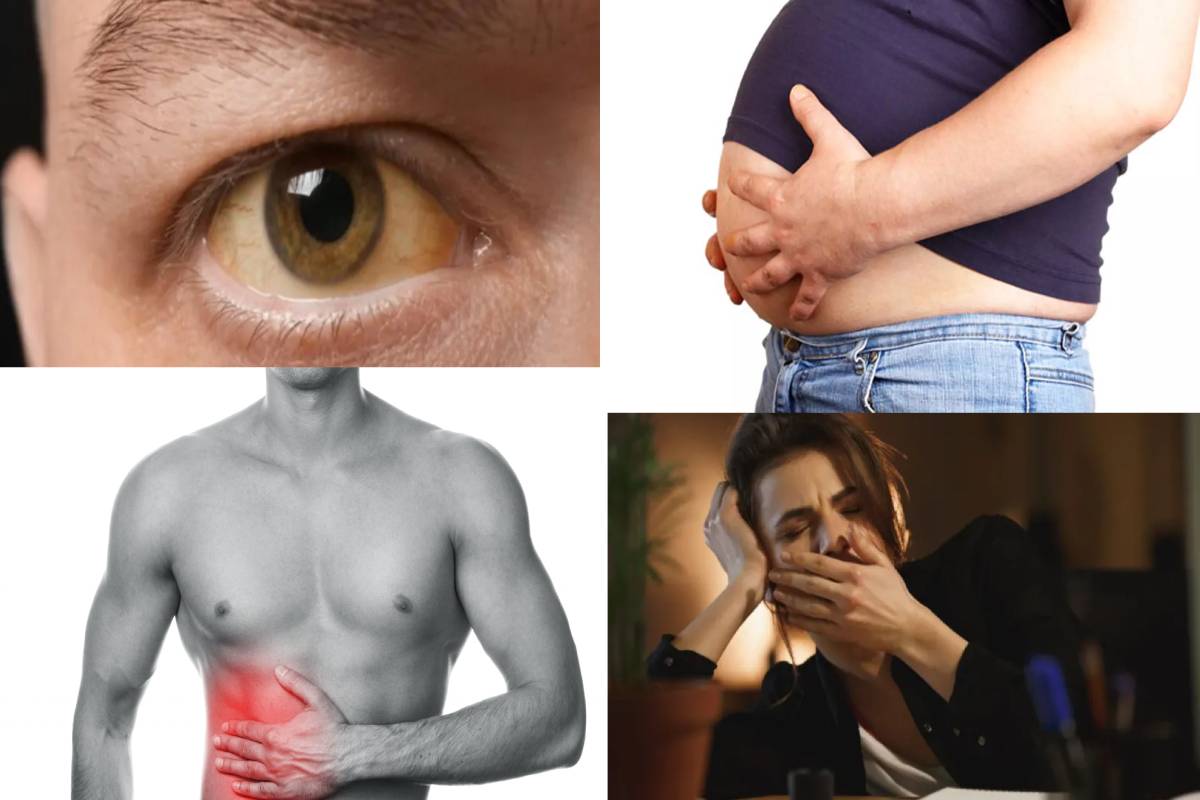 இந்த 5 அறிகுறிகள் இருக்கா? அப்போ உங்கள் கல்லீரல் பத்திரம் | 5 Symptoms Of Fatty Liver How To Find Out