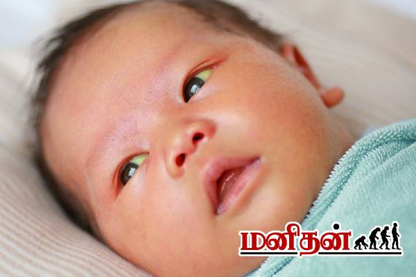 மஞ்சள் காமாலை நோய்: மருத்துவரின் விரிவான விளக்கம் | Jaundice About Full Details In Tamil