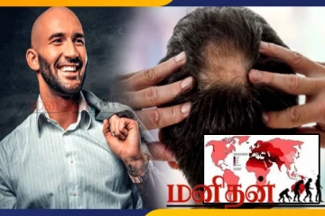 அதிகமான ஆண்கள் வழுக்கை தலையுடன் இருக்கும் நாடுகள்- என்ன காரணம்?