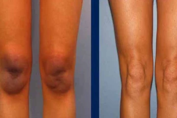 கால் முட்டி, அக்குள் ரொம்ப கருப்பா இருக்கா?