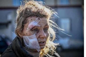 முகம் முழுவதும் கண்ணாடி துகள்களுடன்  ரஷ்ய ஏவுகணை தாக்குதலில் உயிர் தப்பிய ஆசிரியை! உலகளவில் வைரலான புகைப்படம்