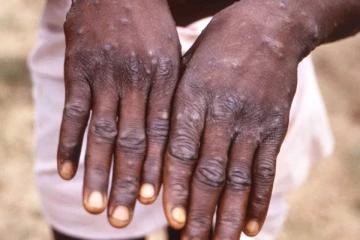 கனடாவில் மங்கி பாக்ஸ் பரவல்.. 10க்கும் மேற்பட்டோருக்கு பாதிப்பு!