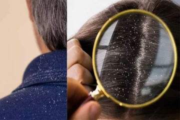 அதிக பொடுகு தொல்லையா? இந்த ஹேர் மாஸ்க் மட்டும் யூஸ் பண்ணி பாருங்க!