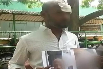 தலையில் ஆப்ரேஷன்; துணியை வைத்து தைத்த மருத்துவர்கள் - கவனக்குறைவால் நேர்ந்த அவலம்!