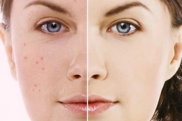 உடலிலுள்ள கொழுப்பே தேங்கியிருந்து பருக்களாக உருமாறுகின்றன..அவற்றை தீர்ப்பதற்கான வழி இதோ!