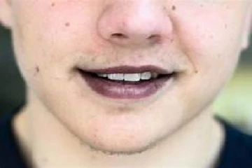 ඔබෙත් තොල් කලු වෙනවාද මෙන්න හේතු..