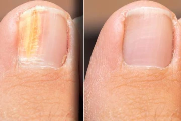 நகம் நொருங்குதா? அப்போ இந்த நோய் உங்களுக்கு இருக்கலாம்