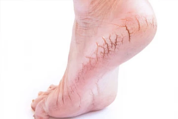 ஒரே நாளில் பித்த வெடிப்பு நீங்க வேண்டுமா? இதோ சில அசத்தலான டிப்ஸ்