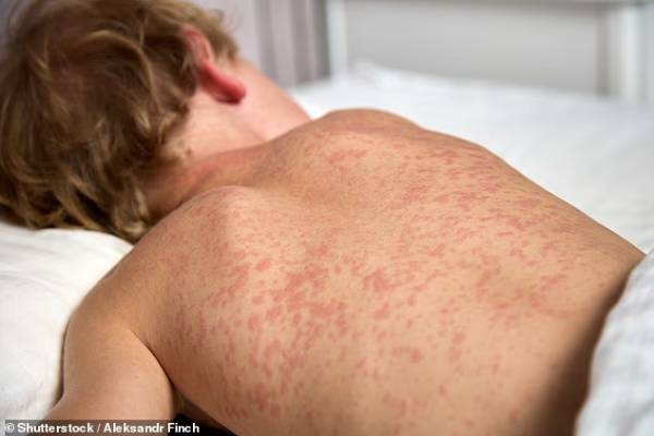 measles spreading in north london 60 children affected