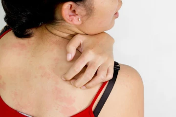 வியர்க்குருவை விரைவாக போக்க வேண்டுமா? இதோ அசத்தலான டிப்ஸ்