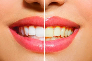 வயதானாலும் பற்கள் முத்துபோல் ஜொலிக்க வேண்டுமா? இந்த டிப்ஸ்களை செய்து பாருங்க