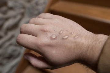 குரங்கு அம்மை தொடர்பில் குழந்தை நல மருத்துவர் வெளியிட்ட தகவல்