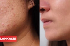 தழும்புகள் மற்றும் பருக்கள் முற்றிலும் மறைக்கனுமா? இதோ சூப்பர் டிப்ஸ்