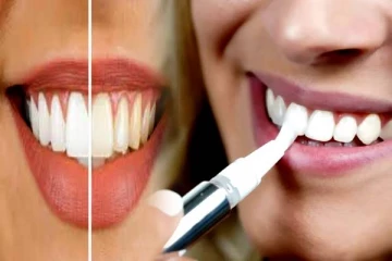 கரை படிந்த பற்களை நொடிப்பொழுதில் வெள்ளையாக்கும் கருவிகள்! நீங்களும் தெரிஞ்சிக்கோங்க..