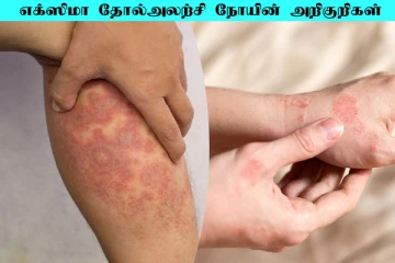 எக்ஸிமா என்னும் தோல் அழற்சி நோய்.... இதன் அறிகுறிகள் என்ன?