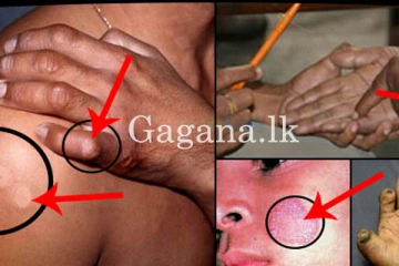 මෙරට ලාදුරු රෝගීන් ඉහළට. - මාසයක් ඇතුලත හමු වූ රෝගීන් සංඛ්‍යාව මෙන්න.