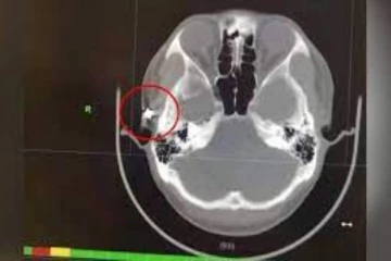 20 வருடமாக தீராத தலைவலி! ஸ்கேன் செய்து பார்த்த மருத்துவர்களுக்கு காத்திருந்த பேரதிர்ச்சி!