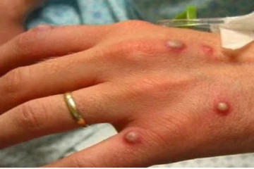 டெல்லியில் மேலும் ஒருவருக்கு குரங்கம்மை - பாதிப்பு 6ஆக உயர்வு!