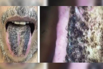 நாக்கில் வளர்ந்த முடி! அதிர்ச்சி சம்பவம்- மருத்துவர் செய்தது என்ன தெரியுமா?