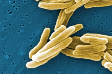 கனேடிய மாகாணம் ஒன்றில் கொரோனாவைத் தொடர்ந்து பரவும் காசநோய்