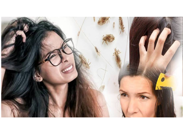 பேன் தொல்லை பாடாய்படுத்துகிறதா? இதோ வீட்டு வைத்தியம் - தமிழ்நாடு