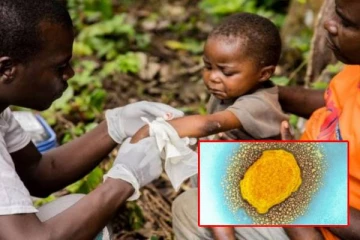 தனிமைப்படுத்துதல் கட்டாயம்... monkeypox பரவல் தொடர்பில் முதல் ஐரோப்பிய நாடு அறிவிப்பு