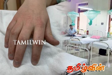 இலங்கையில் முதல் முறையாக பதிவான அரிய நோய் - உறுதி செய்த ஜெர்மன் மருத்துவர்கள்