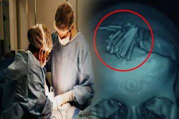 இந்தியாவில் பெண்ணின் தலையில் ஏற்றப்பட்ட 77 ஊசிகள்: 4 ஆண்டுகளுக்கு பிறகு வெளிவந்த உண்மை