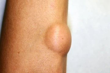 திடீர்னு இப்படி கொழுப்பு கட்டி வருதா...ஆபத்து! உடனே மஞ்சள் பால் குடிங்க - ஏன் தெரியுமா?